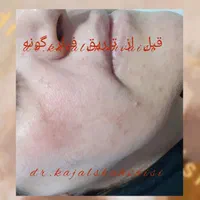 تزریق تخصصی ژل بوتاکس و جوانساز در مطب خانم دکتر|خدمات آرایشگری و زیبایی|سنندج, |دیوار