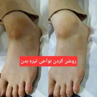 پاک کردن تتو و خالکوبی با دستگاه لیزر کیوسوئیچ|خدمات آرایشگری و زیبایی|اندیشه, اندیشه فاز ۱|دیوار