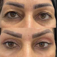 ژل بوتاکس،بلفاروپلاستی،پی آر پی،فیشیال ساکشن غبغب|خدمات آرایشگری و زیبایی|تبریز, |دیوار