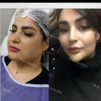 بوکالفت/ساکشن غبغب/ساکشن شکم/تزریق چربی باسن/فیلر