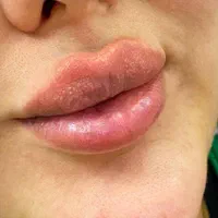 تزریق ژل فیلر بوتاکس مزوژل|خدمات آرایشگری و زیبایی|مشهد, طبرسی شمالی|دیوار