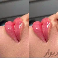 فیلر لب چانه گونه زاویه بوتاکس هایفو ژل مزو لیزر|خدمات آرایشگری و زیبایی|مشهد, فرهنگ|دیوار