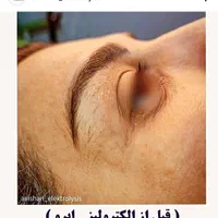 تخفیف الکترولیز،(×لیزر نیست) حذف دائم موهای زائد|خدمات آرایشگری و زیبایی|یاسوج, |دیوار