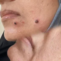خال برداری و رفع انواع خال و خالبرداری|خدمات آرایشگری و زیبایی|اهواز, کیانپارس |دیوار