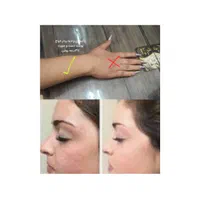 برداشتن انواع خال لک زیگیل تناسلی و...|خدمات آرایشگری و زیبایی|اصفهان, شهرک کوثر|دیوار