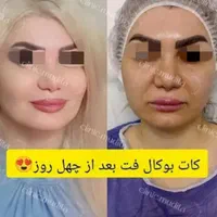 بوکالفت/ساکشن غبغب/ساکشن شکم/تزریق چربی باسن/فیلر|خدمات آرایشگری و زیبایی|تهران, صادقیه|دیوار