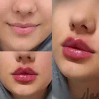 تخفیف ویژه پی ار پیprpفیلرژل بوتاکس کامپوزیت|خدمات آرایشگری و زیبایی|اهواز, کیان اباد|دیوار