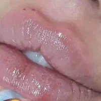 تزریق ژل،بوتاکس،خال برداری،مزوی مو و صورت|خدمات آرایشگری و زیبایی|بندر کنگان, |دیوار