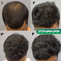۸۰درصد تخفیف در/لیزر/مزوتراپی/prp/جوانساز|خدمات آرایشگری و زیبایی|اندیشه, اندیشه فاز ۴|دیوار