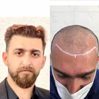 کاشت مو وابرو وریش(نقد واقساط ) اقساطی|خدمات آرایشگری و زیبایی|شیراز, بعثت|دیوار