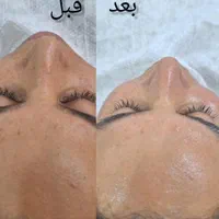 تکنیک مزووایت(روشن کننده پوست) کرمپودر دائم|خدمات آرایشگری و زیبایی|لاهیجان, انقلاب|دیوار