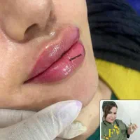 تزریق ژل و بوتاکس و آموزش حرفه ای
