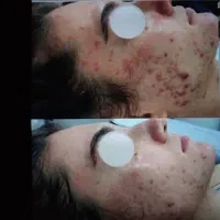 درمان تخصصی ،فیشال و اسیدتراپی و ماساژ درمانی صورت|خدمات آرایشگری و زیبایی|شیراز, رحمت‌آباد|دیوار