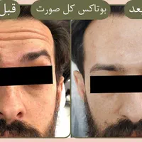 جشنواره بوتاکس،فیلر،‌لب روسی،جوانسازی،توسط پزشک|خدمات آرایشگری و زیبایی|زنجان, |دیوار