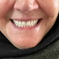دست دندان متحرک/تعمیر دندان مصنوعی|خدمات آرایشگری و زیبایی|کرج, چهارصد دستگاه|دیوار