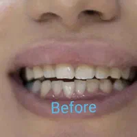 آفرلمینت‌دندان‌وروکش|خدمات آرایشگری و زیبایی|تهران, شهرک ولیعصر جنوبی|دیوار