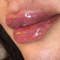 جشنواره تزریق ژل و بوتاکس مزوتراپی مزوژل|خدمات آرایشگری و زیبایی|شیراز, تحویلی|دیوار