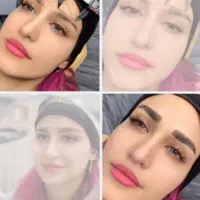 میکروبلیدینگ ،فیبروز،ارایش دائم،کراتین