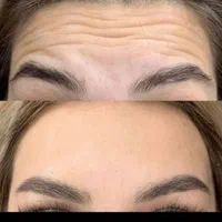 تخفیف تزریق ژل بوتاکس هایفولیزر فیلربادی لیفت بانخ|خدمات آرایشگری و زیبایی|تهران, ستارخان|دیوار