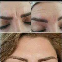 تزریق ژل وبوتاکس|خدمات آرایشگری و زیبایی|گلبهار, |دیوار