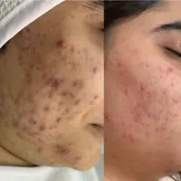 درمان مشکلات پوست مطب/مزوتراپی/فشیال/مزونیدلینگ/ژل|خدمات آرایشگری و زیبایی|مشهد, دانشجو|دیوار
