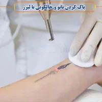 پاک‌کردن تتو با لیزر در استان یزد|خدمات آرایشگری و زیبایی|یزد, |دیوار