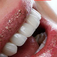 دندانپزشکی ایمپلنت کامپوزیت ارتودنسی لمینت روکش|خدمات آرایشگری و زیبایی|تبریز, |دیوار