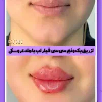 تزریق فیلر ژل بوتاکس هایفو فشیال لیزرکاملا اقساطی|خدمات آرایشگری و زیبایی|اردبیل, |دیوار