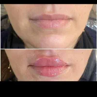 تزریق ژل وبوتاکس،نخ کاگ یالیفت صورت،اموزش|خدمات آرایشگری و زیبایی|تهران, شهرک شریعتی|دیوار