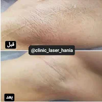 جشنواره بهاری لیزر موی زائد فول ۴۲۰ به مدت محدود|خدمات آرایشگری و زیبایی|ارومیه, |دیوار