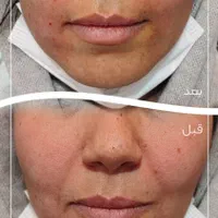 ژل خط خنده ( شوش)