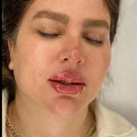 ژل لب و صورت بوتاکس|خدمات آرایشگری و زیبایی|رشت, گلسار|دیوار