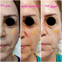 هایفوتراپی،لیفت وجوانسازی صورت،رفع غبغب|خدمات آرایشگری و زیبایی|تهران, ظفر|دیوار