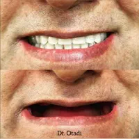 ساخت دست دندان مصنوعی طرح لمینیت و لبخند باضمانت|خدمات آرایشگری و زیبایی|تهران, طیب|دیوار