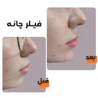 فیلر چروک های صورت|خدمات آرایشگری و زیبایی|شوش, |دیوار