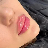 تزریق ژل بوتاکس توسط پزشک|خدمات آرایشگری و زیبایی|کرمانشاه, |دیوار