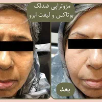 جشنواره بوتاکس،فیلر،‌لب روسی،جوانسازی،توسط پزشک|خدمات آرایشگری و زیبایی|زنجان, |دیوار