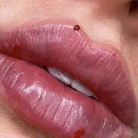 تزریق ژل لب . بوتاکس با ماندگاری بالا لیزر PRP