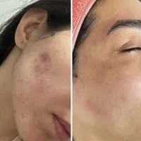 پاکسازی و فیشیالvip پوست 180ویژه ۳روز|خدمات آرایشگری و زیبایی|مشهد, آزادشهر|دیوار