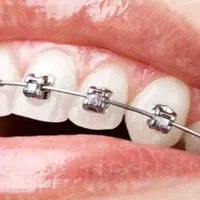 ارتودنسی ثابت ومتحرک|خدمات آرایشگری و زیبایی|شیراز, قصرالدشت|دیوار