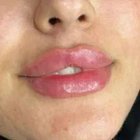 تزیق فیلروبوتاکس لیزر موهای زائد هایفو خالبرداری|خدمات آرایشگری و زیبایی|بوشهر, |دیوار