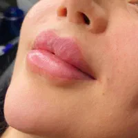 تزریق ژل فیلر بوتاکس مزوژل|خدمات آرایشگری و زیبایی|مشهد, طبرسی شمالی|دیوار