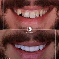 کامپوزیت دندان/لمینیت/دندانپزشکی|خدمات آرایشگری و زیبایی|مشهد, کوثر|دیوار