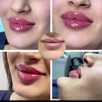 تزریق ژل و بوتاکس در شرق تهران|خدمات آرایشگری و زیبایی|تهران, نظام‌آباد|دیوار