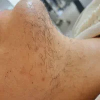 الکترولیز.پیرسینگ.پلاسما.خالبرداری|خدمات آرایشگری و زیبایی|سنندج, |دیوار