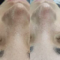 فیشال و پاکسازی پوست|خدمات آرایشگری و زیبایی|شیراز, عادل آباد|دیوار
