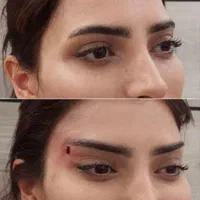 زیبایی لیفت بلفارو فرم بینی بوتاکس نخ ابروزاویه ژل|خدمات آرایشگری و زیبایی|اصفهان, بهارستان|دیوار