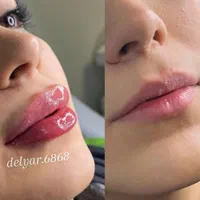 تخفیف ویژه فیلرلب،ژل،انزیم لب،بوتاکس،پی ار پی|خدمات آرایشگری و زیبایی|بندرعباس, |دیوار