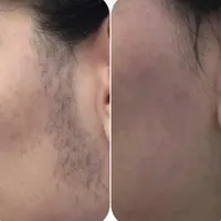 سرم/رفع/موهای زائد/بدن/صورت|خدمات آرایشگری و زیبایی|لاهیجان, انقلاب|دیوار