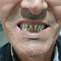 دندانسازی، دندان سازی، دندان مصنوعی، تعمیر شکستگی|خدمات آرایشگری و زیبایی|مشهد, یوسفیه|دیوار